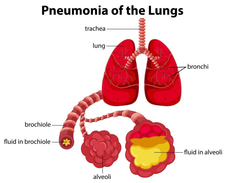 Hindari Pneumonia Dengan Hidup Sehat